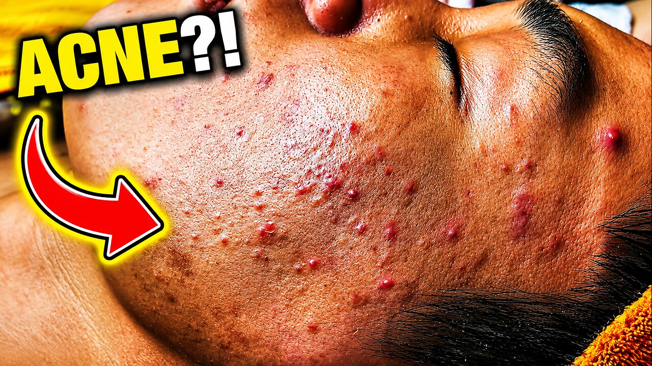 Relaxing Skincare Routing Cleansing For Blackheads And Pimple Removal Treatment