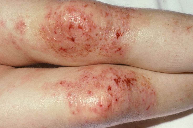 What Does Eczema Look Like in Different Stages?