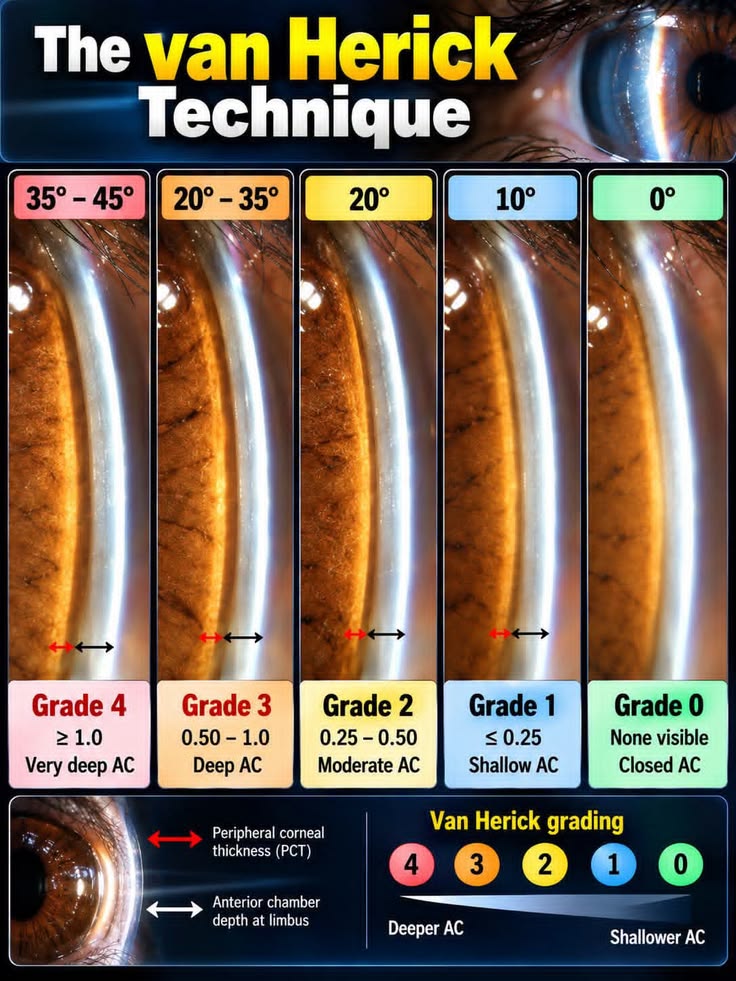 The Van Herick technique is a rapid, non-invasive slit-lamp 