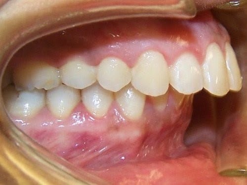 Nhiều người thường dùng "răng vẩu" và "răng hô" như nhau, nh
