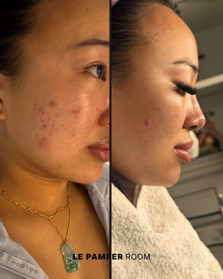 Struggling with acne? You’re not alone.
With the right treat