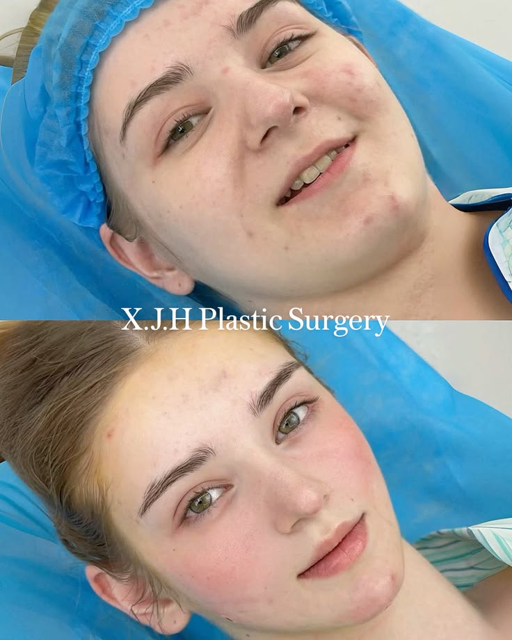Babyface Triple Lift™ - A 3-Step Lift for a Youthful Face #b