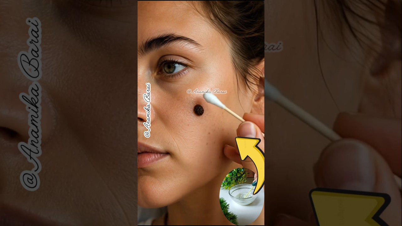 💯Remove Skin Tags & Warts/Best Hack For Mole,Skin Tags #shorts #skincare #skintags #warts #ytshorts
