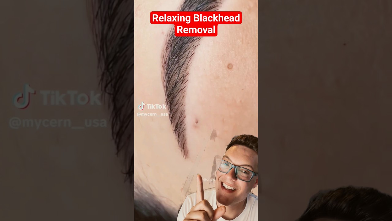 RELAXING BLACKHEAD REMOVAL - Crazy Satisfying #shorts