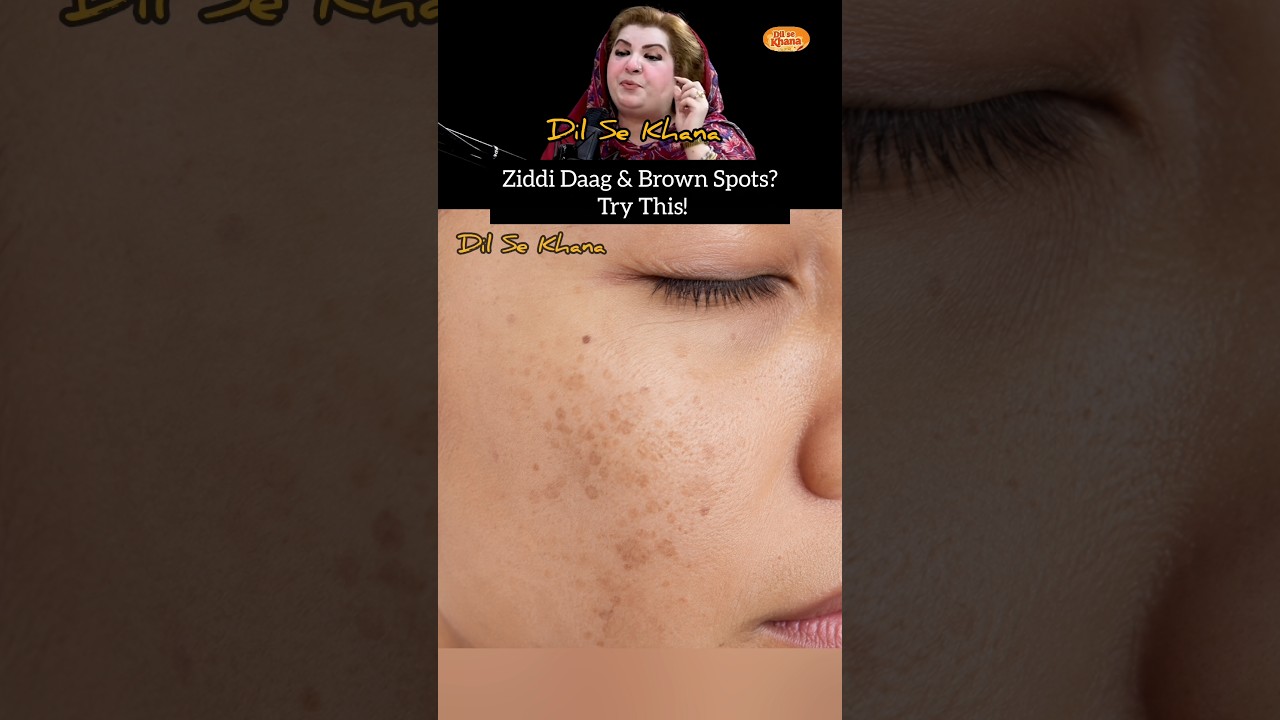 Ziddi Daag-Brown Spots Ke Liye Jeera Water|Easy Home Remedy #ytshorts #shorts #fyp #pigmentation #yt