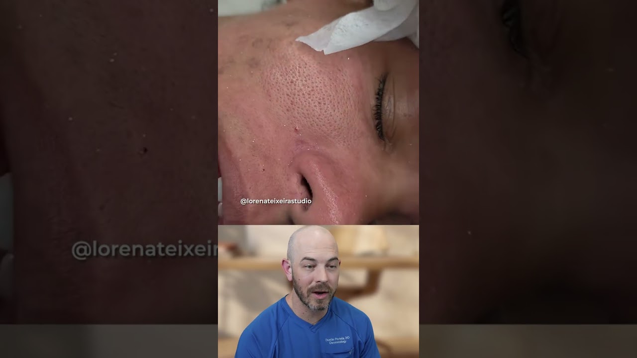 Sebaceous filaments on the nose