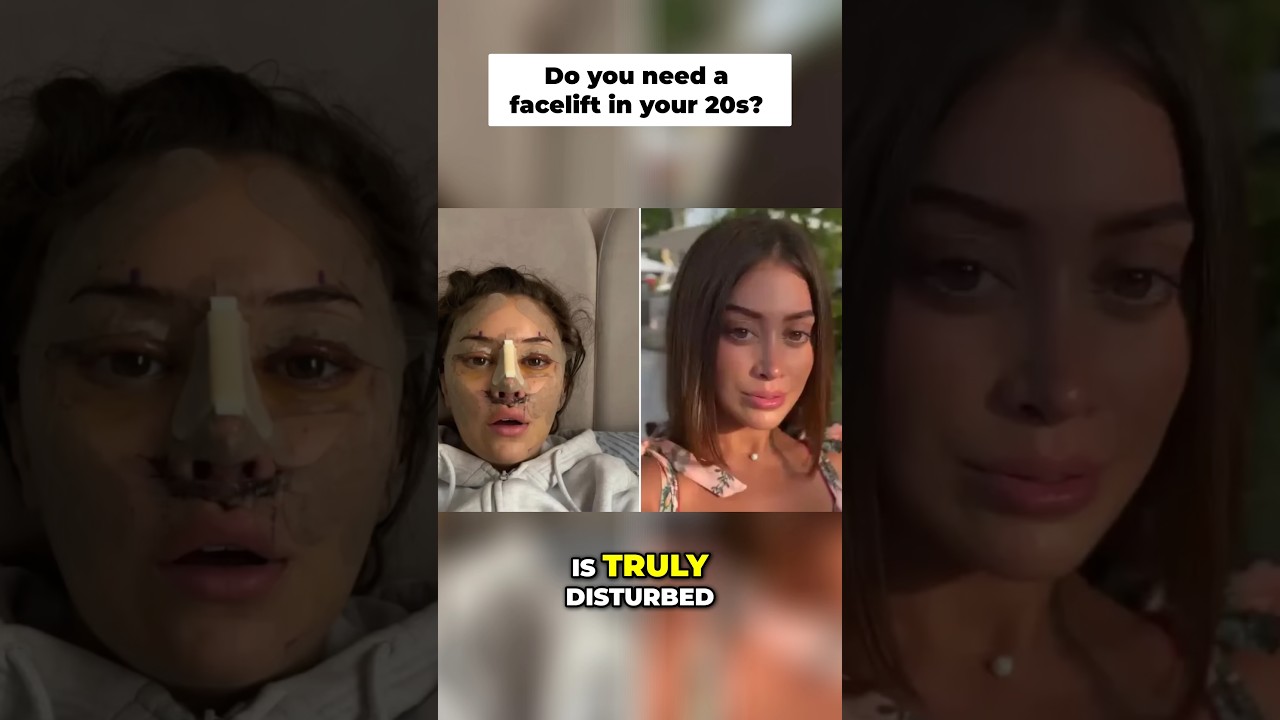 Facelifts are EXPLODING in women under 28… 😟 #beautystandards #facelifts #faceliftresults