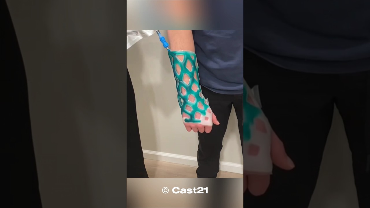 “This Waterproof Cast Changes Everything for Broken Arms”