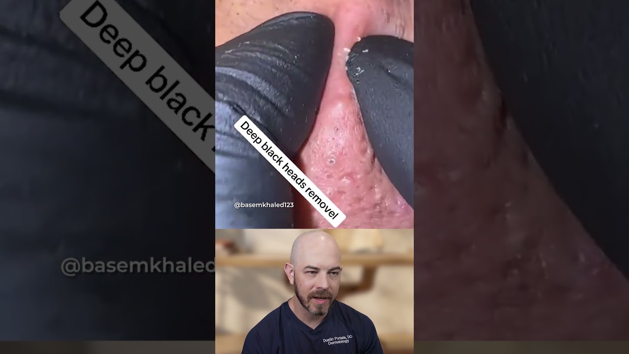 Deep blackheads removal! #skincare #blackheads