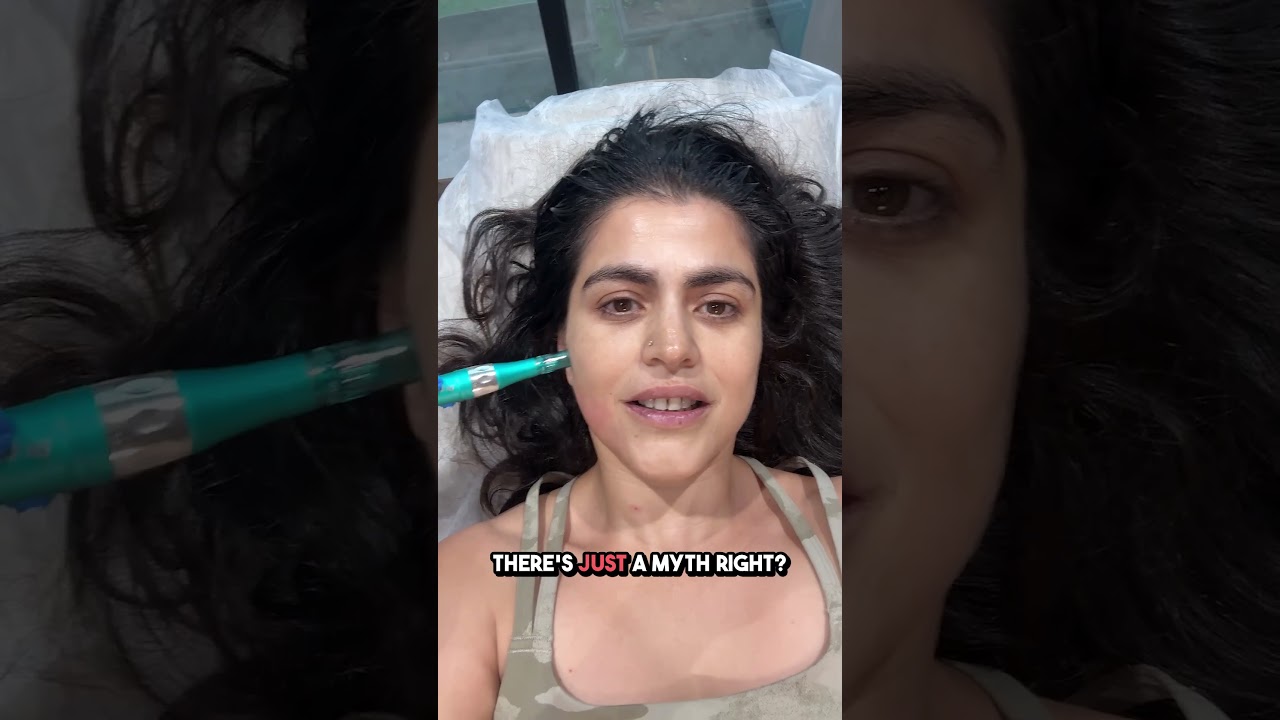I Tried the Vampire Facial: Here's What Happened #vampirefacial #shorts #skincare