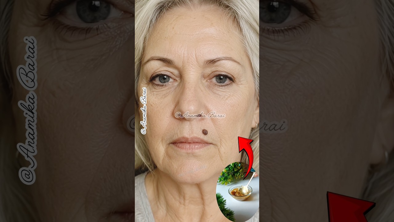 💯Skin Tags Removal/DIY Warts & Skin Tags Hack #shorts #skincare #warts #skintags #moles #ytshorts