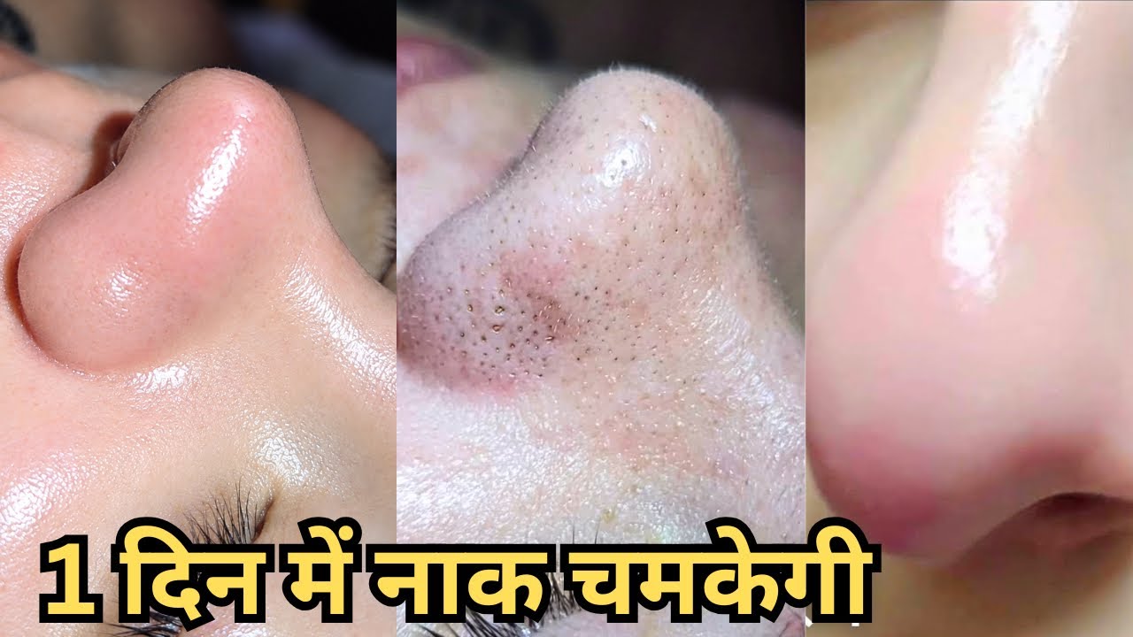 Skin चमकेगी| नाक, Cheeks से Clogged Pores, Blackheads, Whiteheads जड़ से खत्म करे सिर्फ 1 दिन मे|