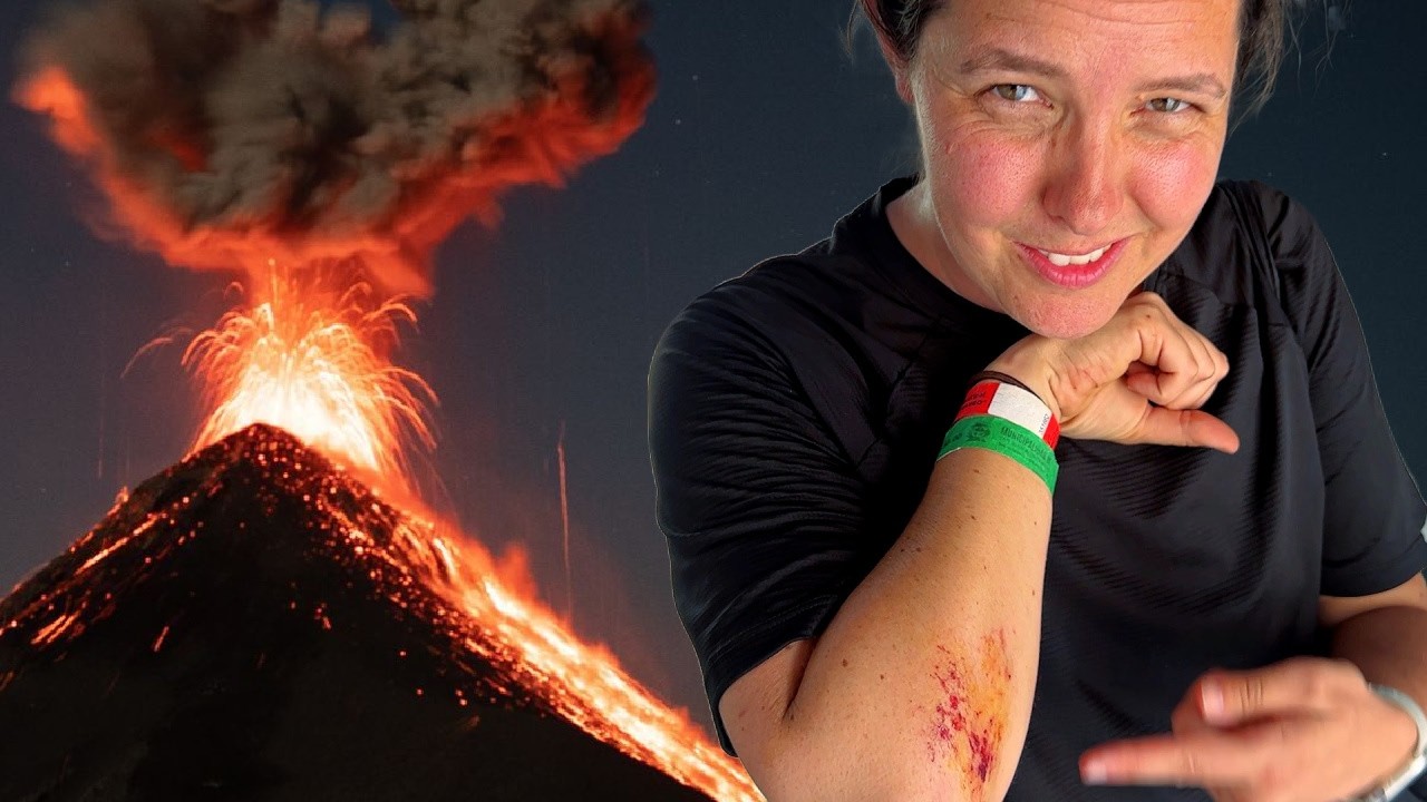 Volcano Injury | Guatemala🇬🇹 6