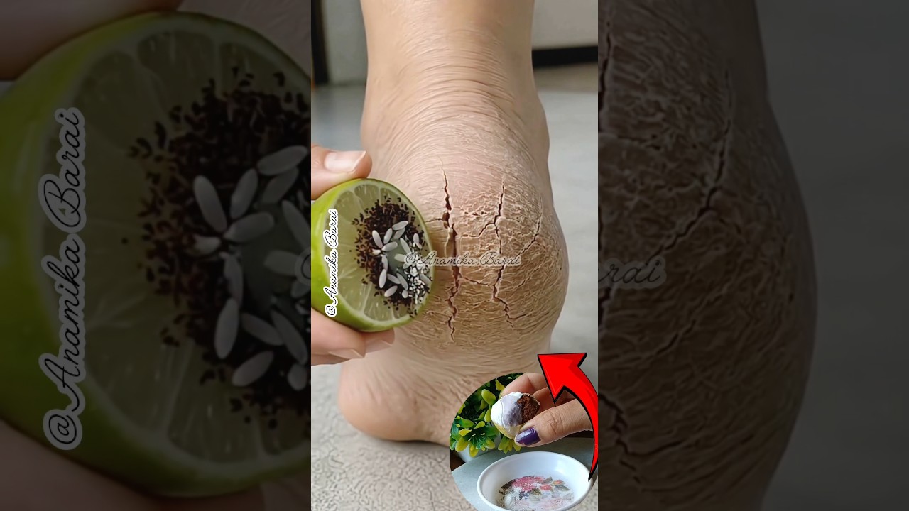 ✅Cracked Heels Problem Solved/Get Baby Soft Heels #shorts #crackedheels #heels #ytshorts #viral
