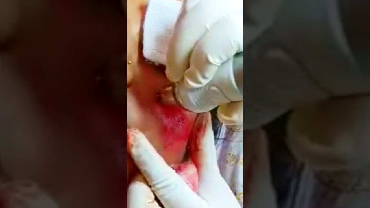 microneedling treatment ll#skincare
