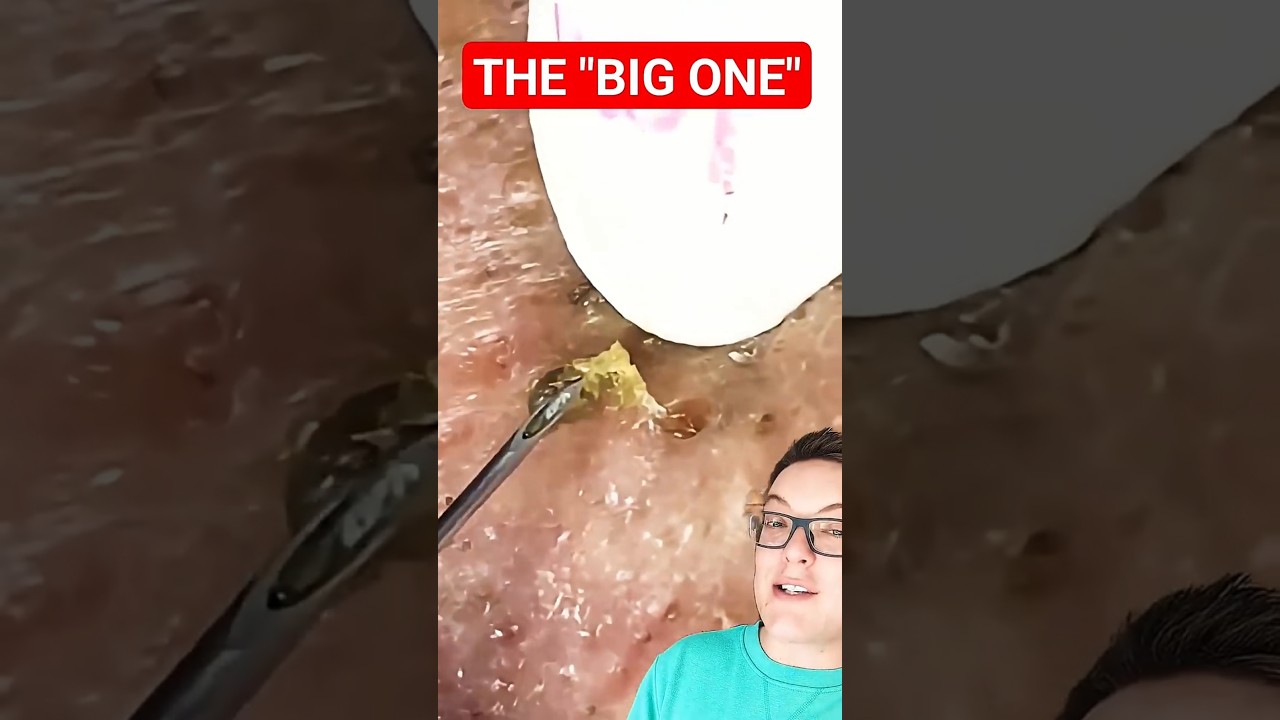 CREEPY BLACKHEAD REMOVAL - What Even Is This #shorts