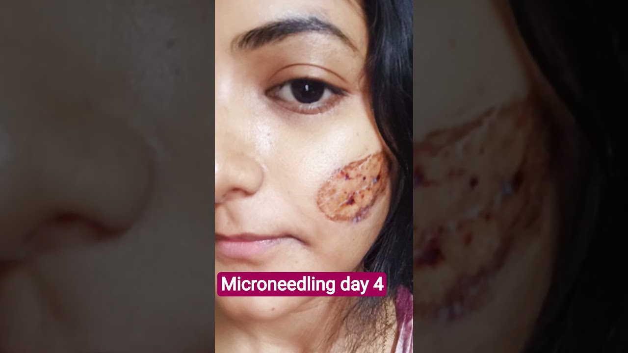 Microneedling treatment day 4 ll#skincare