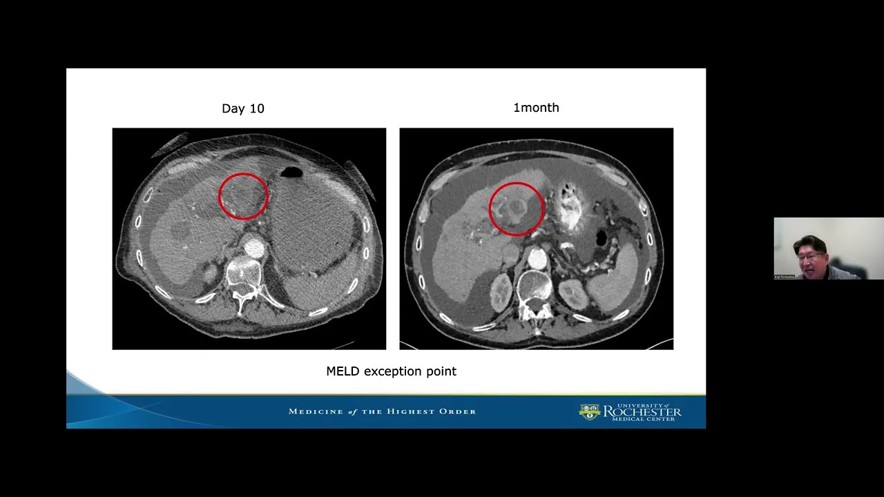 Histotripsy: a novel technology realizing "non-invasive surgery" for hepatic malignancies