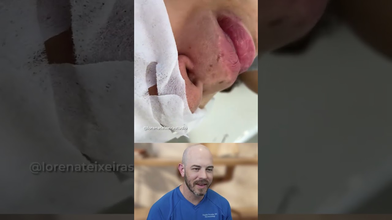 This lip line extraction is crazy