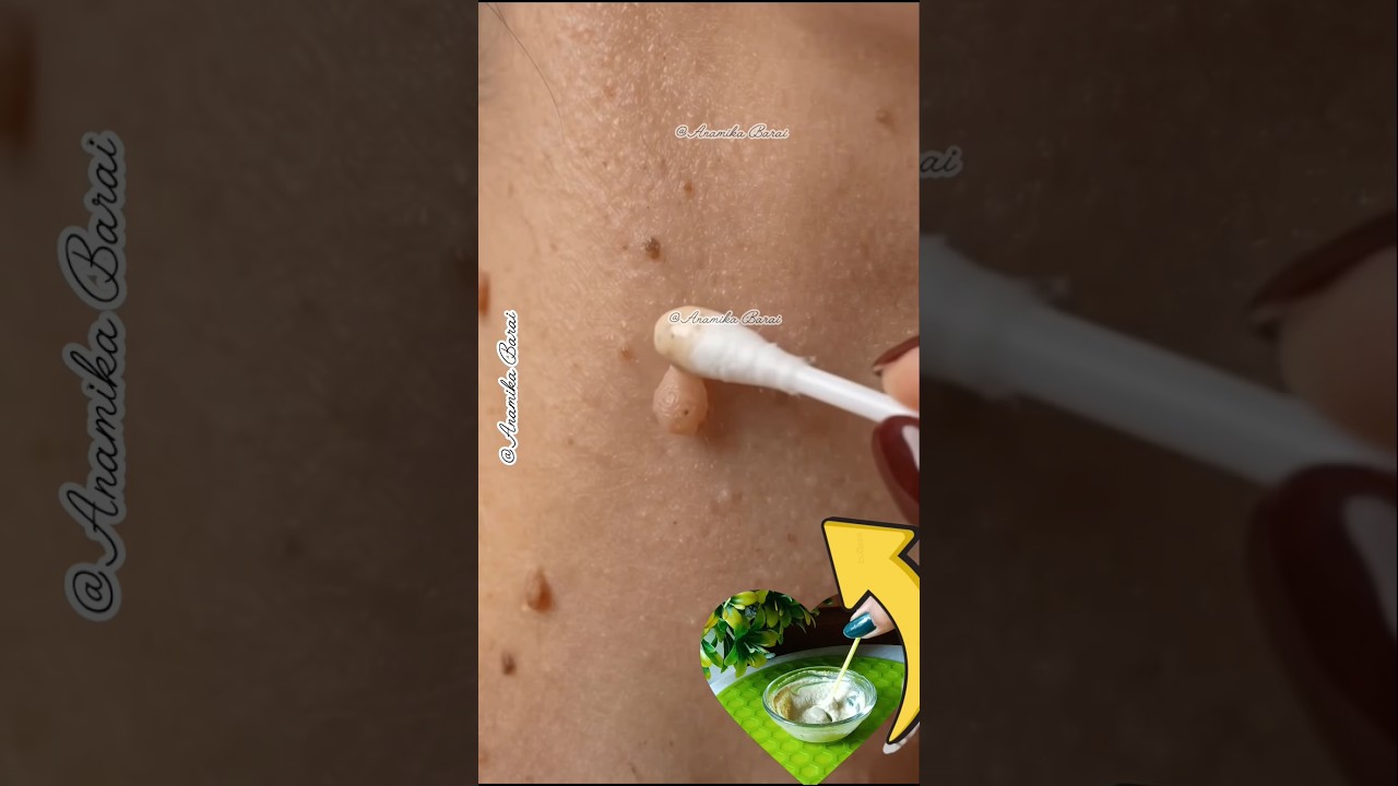 ✅Skin Tags Easily Remove At Home/Warts & Skin Tags Problem Solved #shorts #skintags #warts #ytshorts