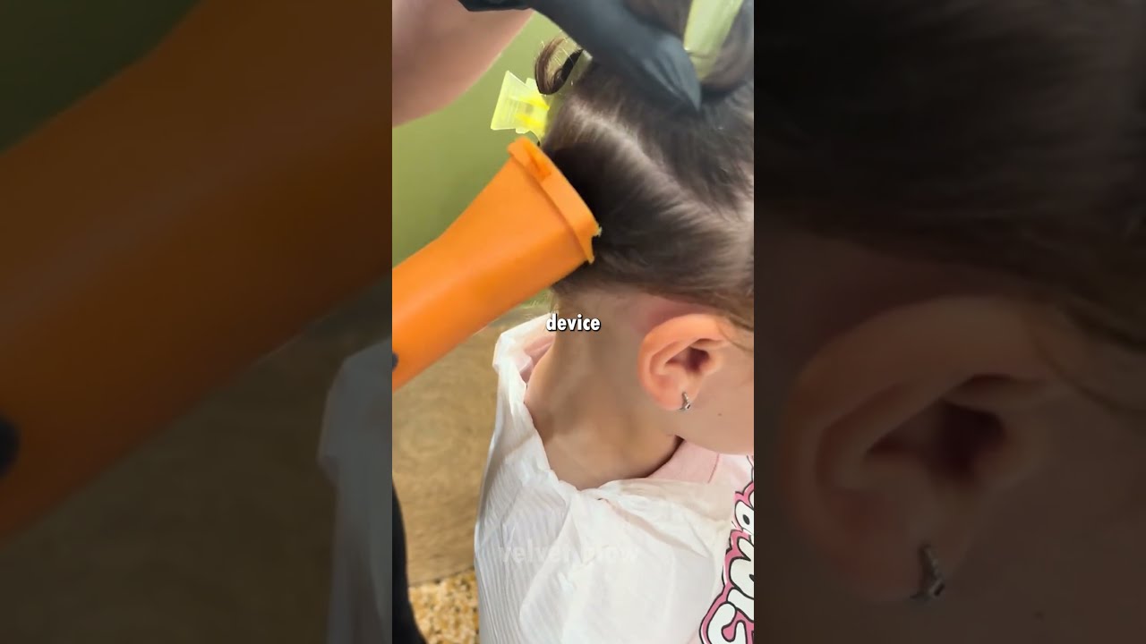 Lice Vacuum for Head Lice 😳🪮  Easy Lice & Nit Removal Method