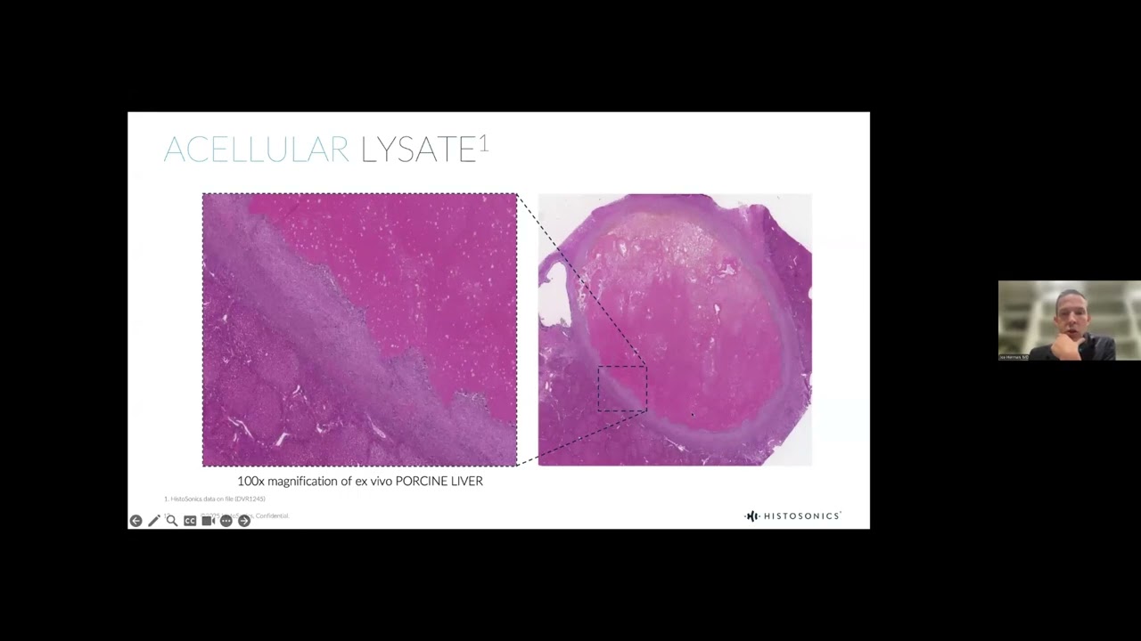 Histotripsy: a novel technology realizing "non-invasive surgery" for hepatic malignancies