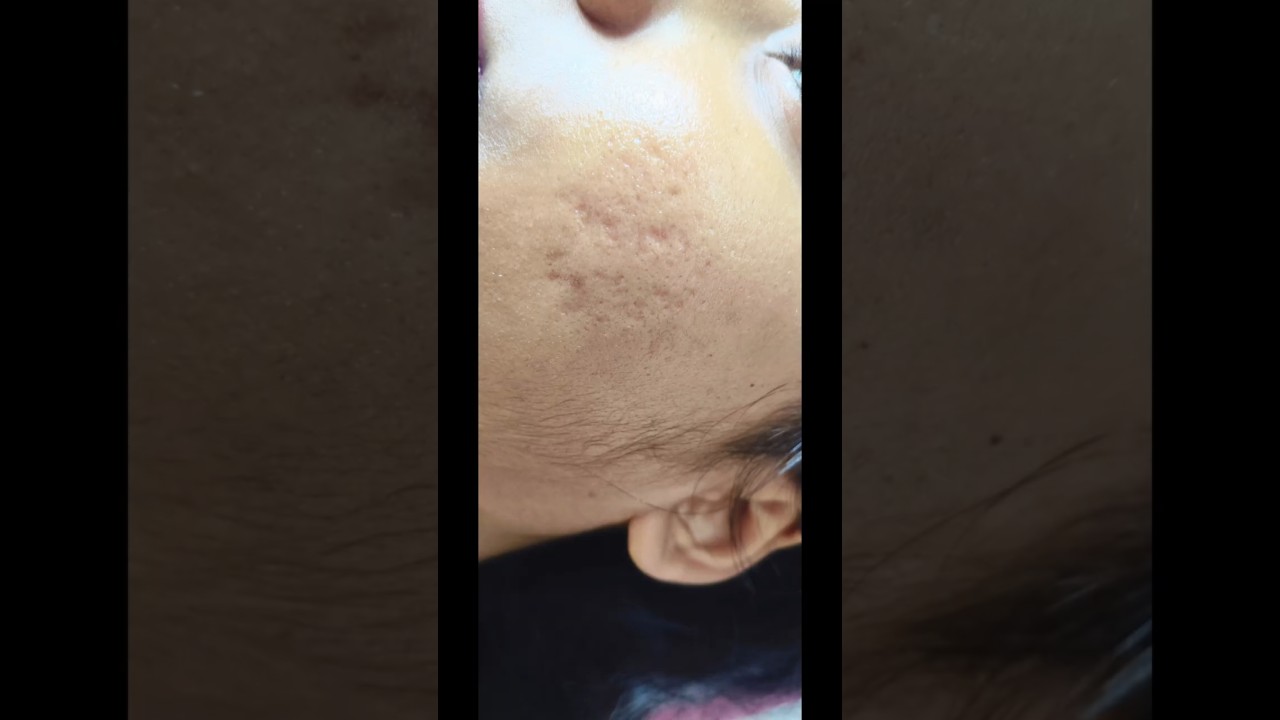 2nd session microneedling treatment ll #microneeding_treatment #skincare