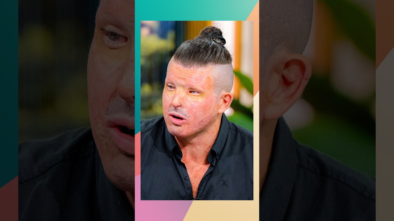 'He threw a pint of acid in my face.' ⚠️ Andreas Christopheros recounts the devastating attack.