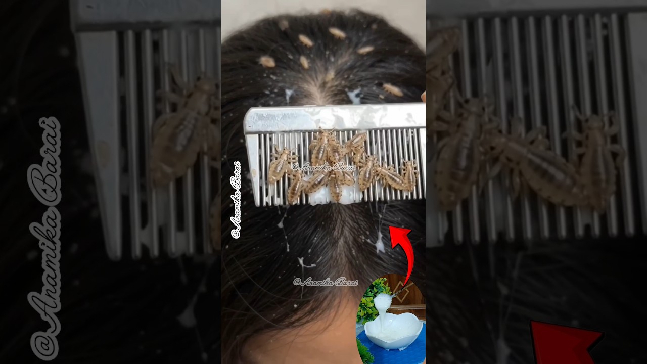 🌿DIY Shampoo For Lice Removal/Nits & Head Lice Problem Solved #shorts #liceremoval #shampoo #viral
