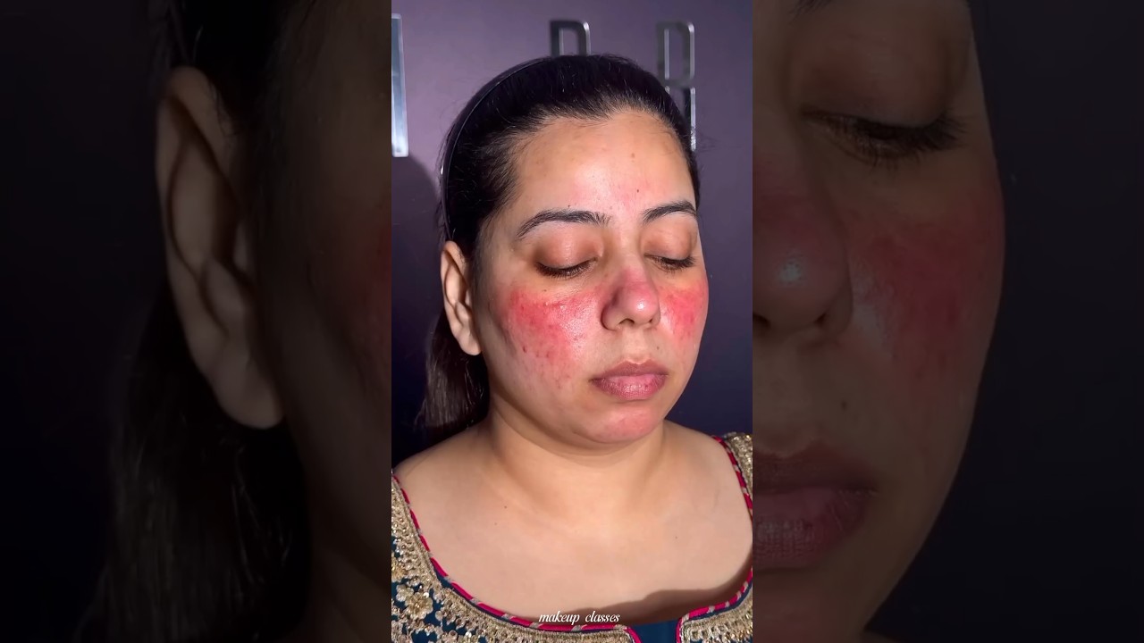 Acne & Redness Cover Makeup Tutorial ✨#makeup #makeuptutorial #makeupartist