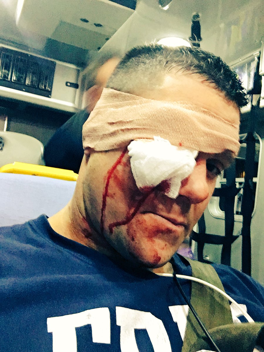 Some Aftermath of a baseball bat to the eye  #PirateLife #Arrrrrrrrrrrrrrrrrrr 