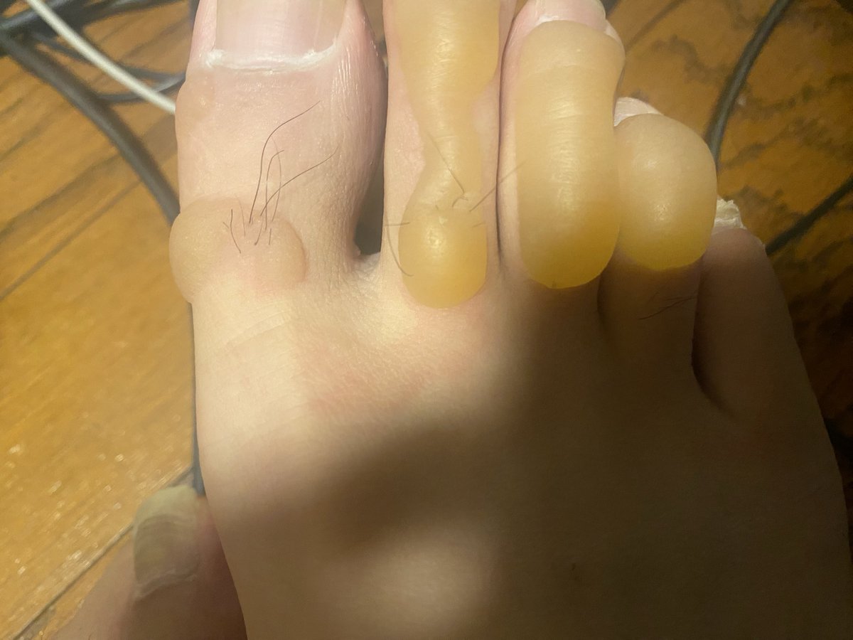 カップ焼きそばのお湯がかかり足がこんなんなってしまいました、明日朝医者行ってきます 