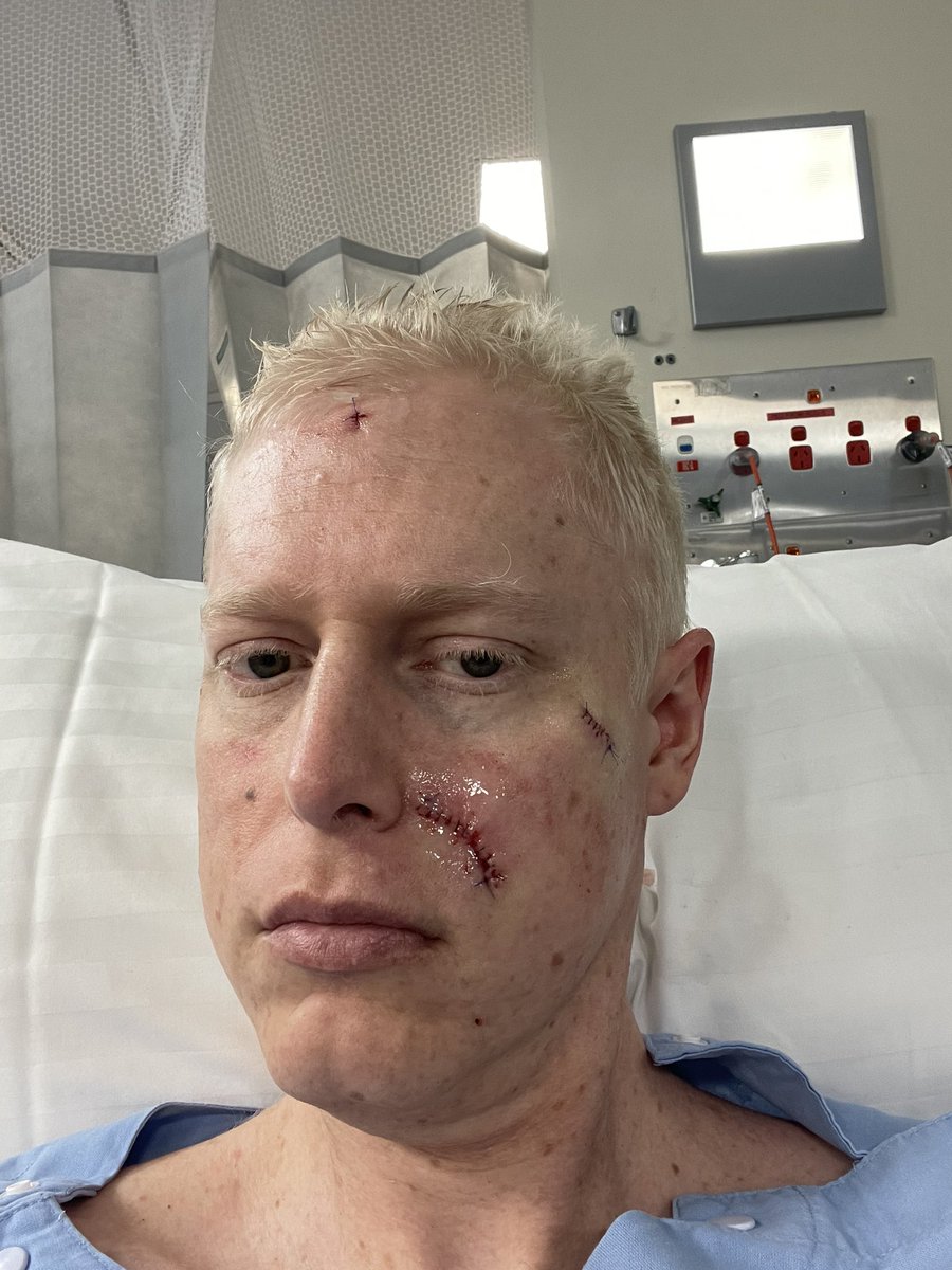 Had to get cancer removed from my face :( fingers crossed the scar is not too bad 