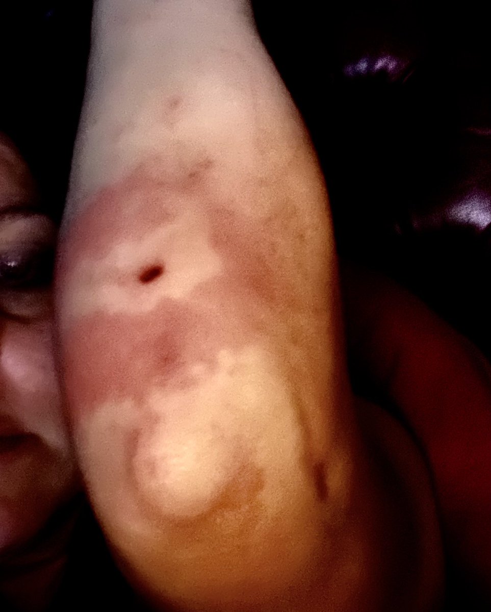 It was confirmed. Lymes was in the UK. Fast forward to last week. I discovered a bite on my arm. A week later it blew up as a bulls eye. Immediately my heart sank. I realised I was feeling nauseous, fatigued, confused; all symptoms I recognised. I made a doctors appointment. 