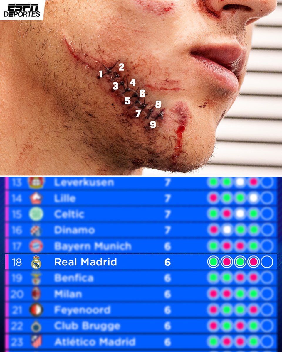 Cubarsí tiene más puntos en la cara que el Madrid en Champions 🫣😅. 