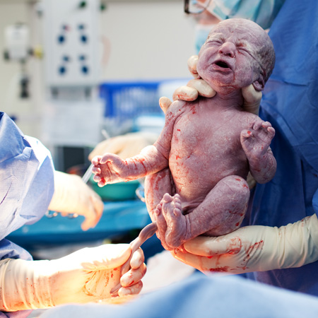 Association Between Cesarean Delivery and Childhood Obesity